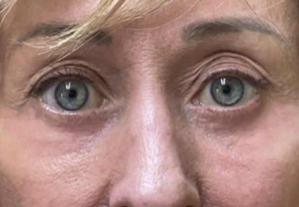 After Laser Resurfacing After Laser Resurfacing